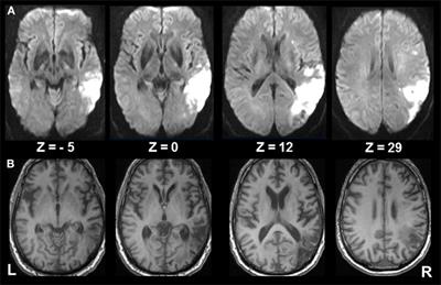 Recovery from Spatial Neglect with Intra- and Transhemispheric Functional Connectivity Changes in Vestibular and Visual Cortex Areas—A Case Study